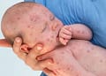 Measles Could Take a Dangerous Turn