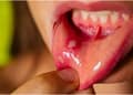 Mouth Ulcers Home Remedies