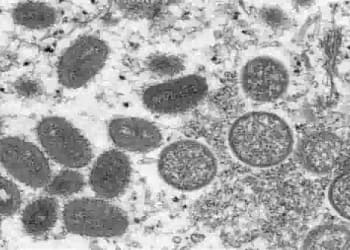 मंकीपाक्स