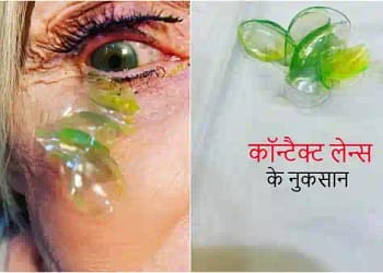 कॉन्टैक्ट लेन्स