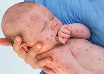 Measles Could Take a Dangerous Turn