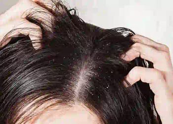 Dandruff