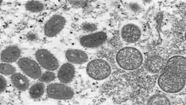 मंकीपाक्स