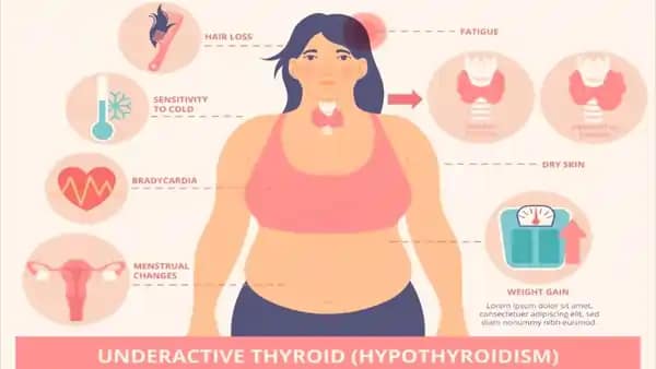 Hyperthyroidism